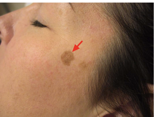 <p><span>How would you document this skin finding?</span></p><p></p>