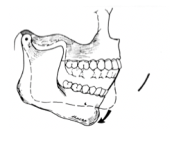 <p>opening 20-25mm = what movement (picture given) </p>