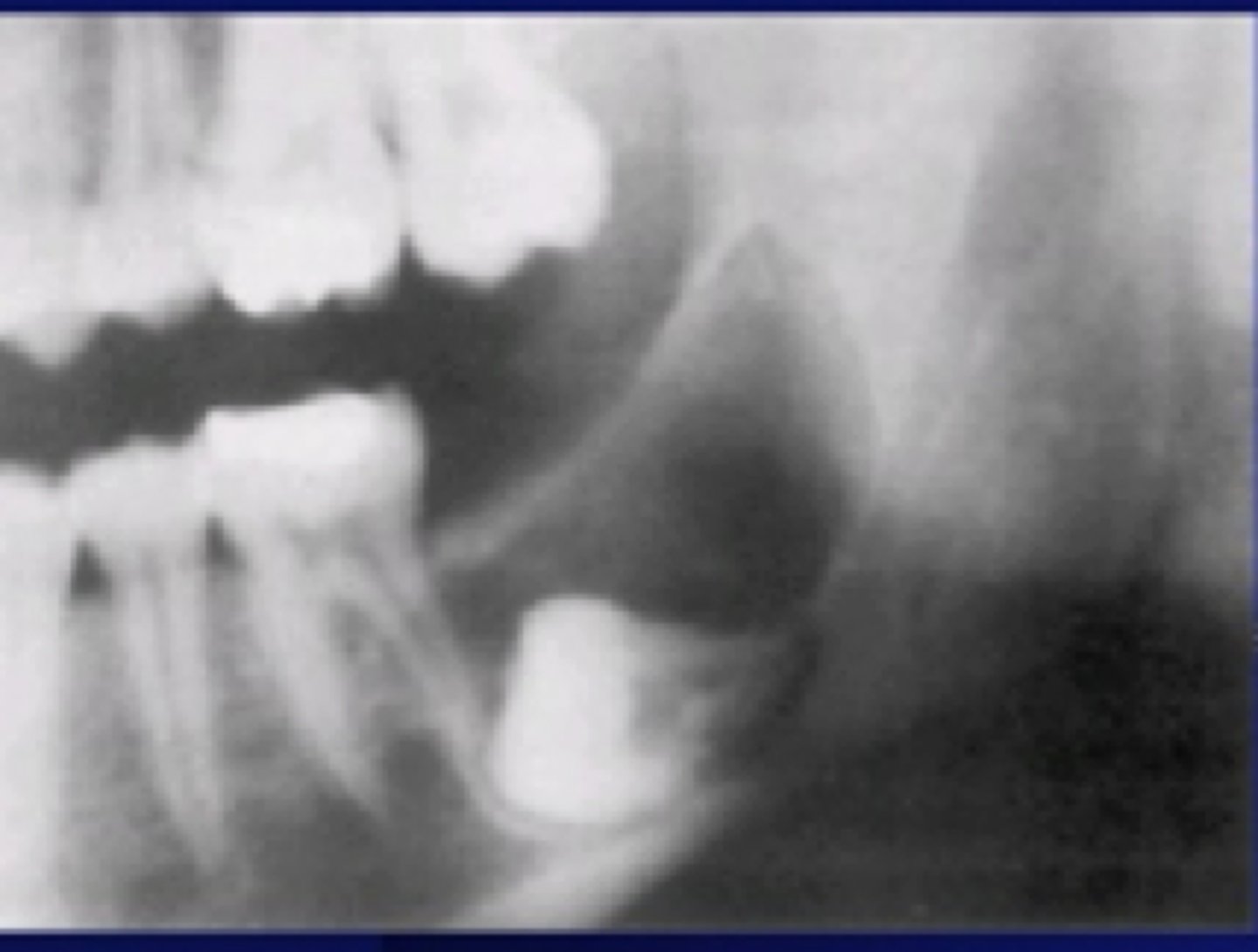 <p>associated with unerupted teeth</p><p>interferes with eruption</p>
