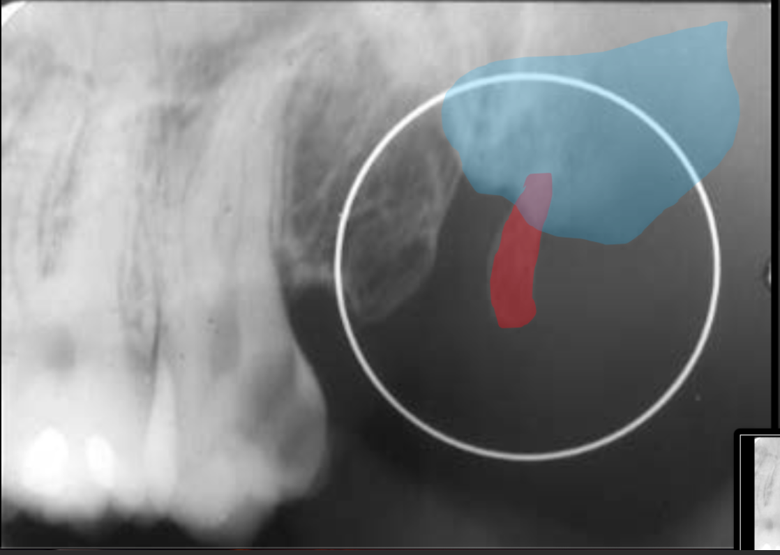 <p>A projection off of the medial pterygoid plate of the sphenoid bone.</p>