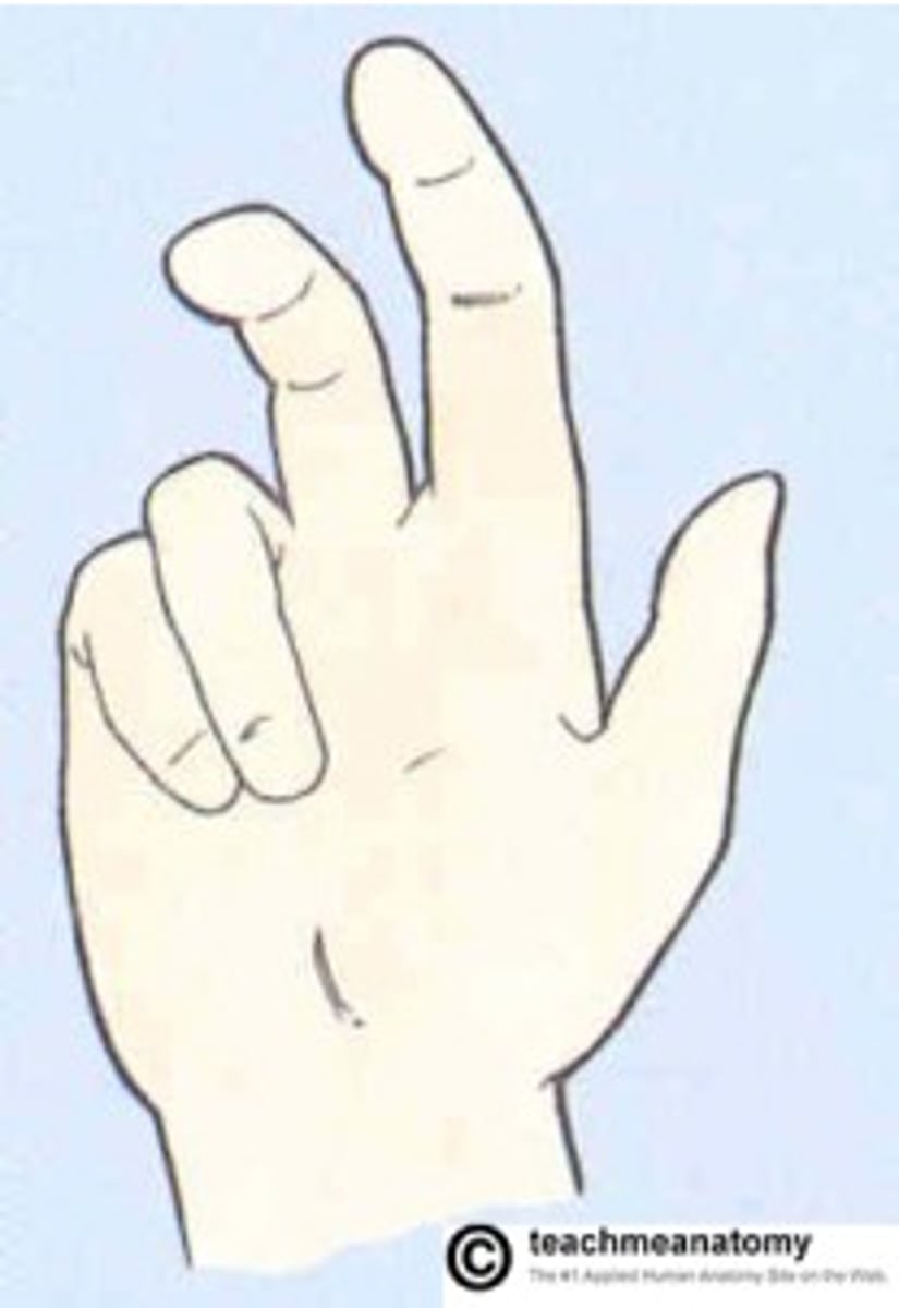 <p>median nerve injury--only digits 4 and 5 flex completely</p>