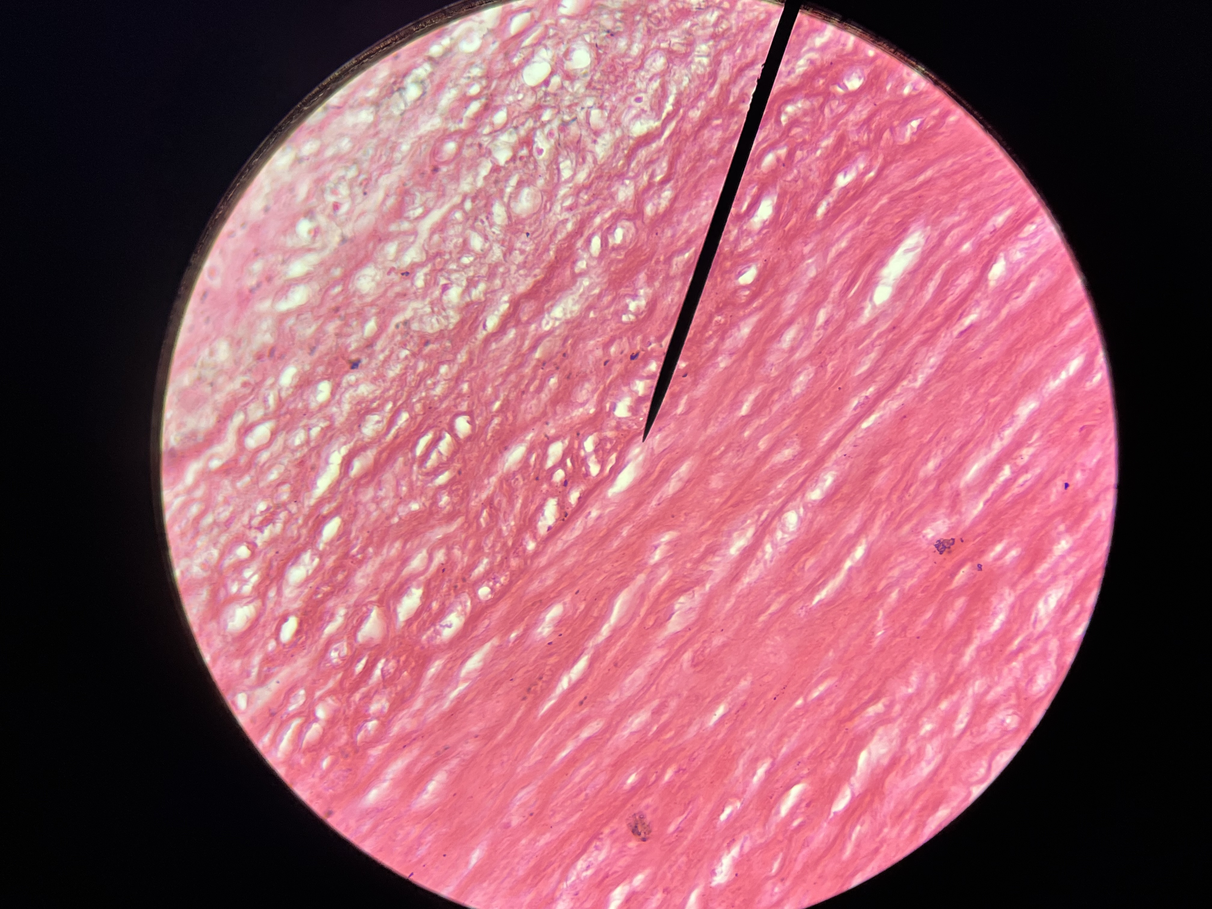 <p><span>characterized by a fibrous cap and a necrotic core, with accumulation of lipids.</span></p>