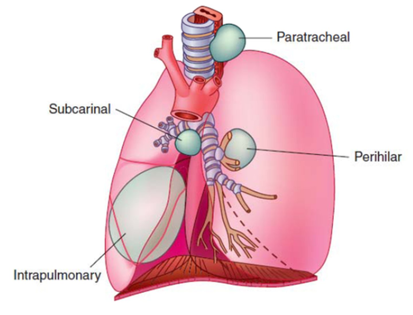 <p>Abnormal budding of the lung primordium. </p><p>- Located in anterior mediastinum, contains respiratory epithelium &amp; cartilage </p>