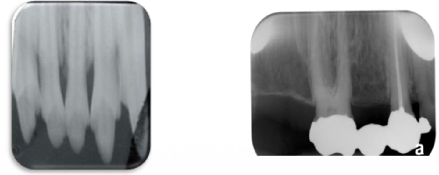 <p>This photo was taken with the bisecting angle technique. What went wrong?</p>