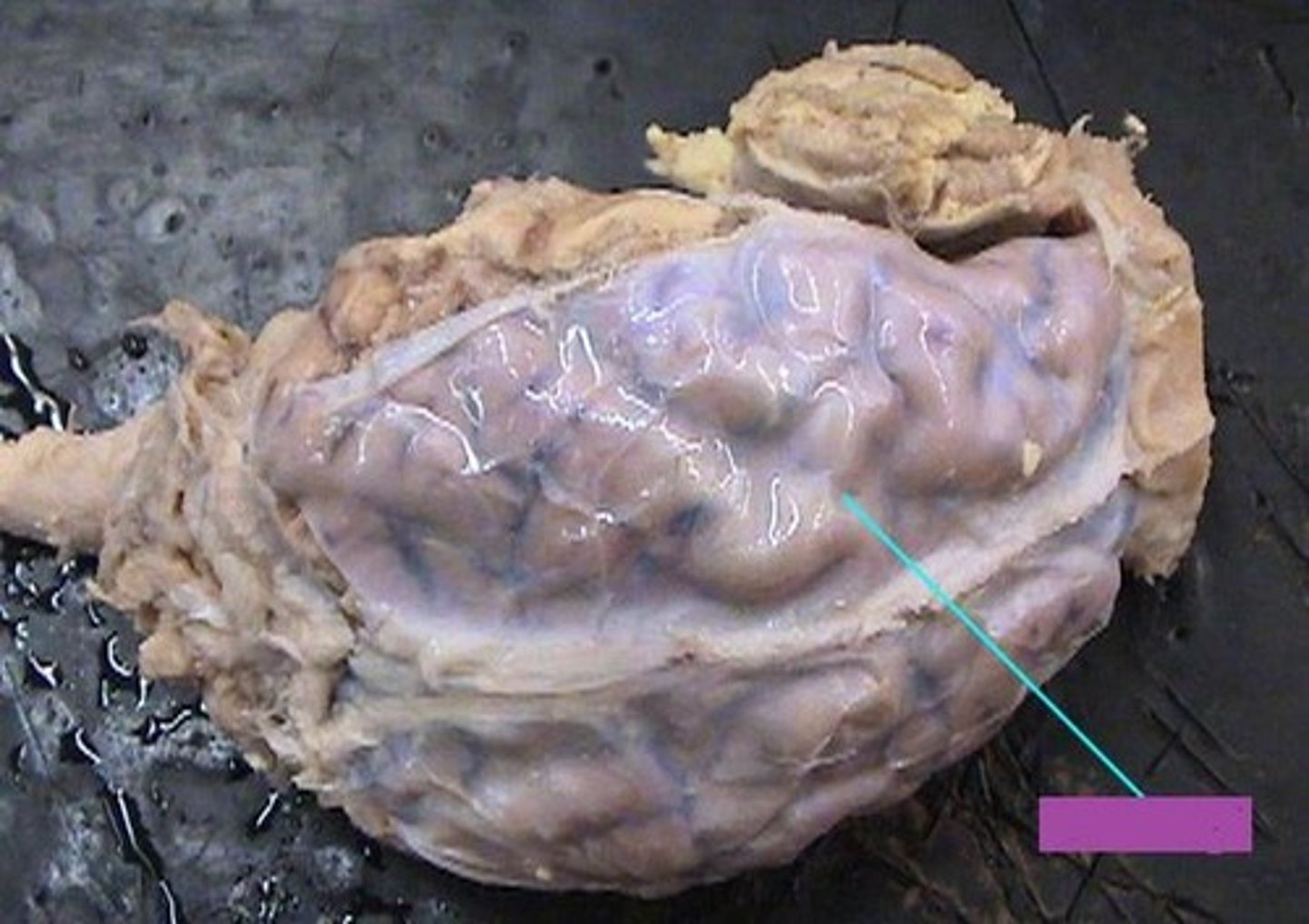 <p>most superficial layer of meninges</p>