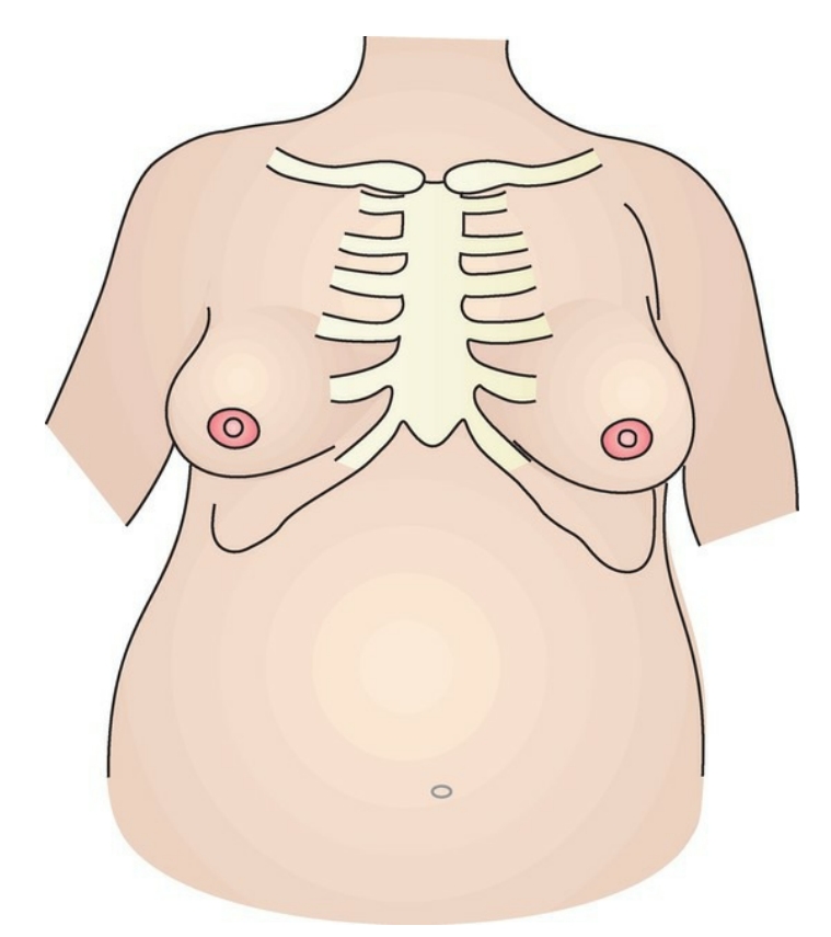 <p>A nurse sees a pregnant woman showing signs of airway obstruction. When the nurse asks the woman if she needs help, the woman nods her head yes. Indicate the area where the nurse’s fist should be placed to effectively administer thrusts to clear the foreign body from the airway.</p>