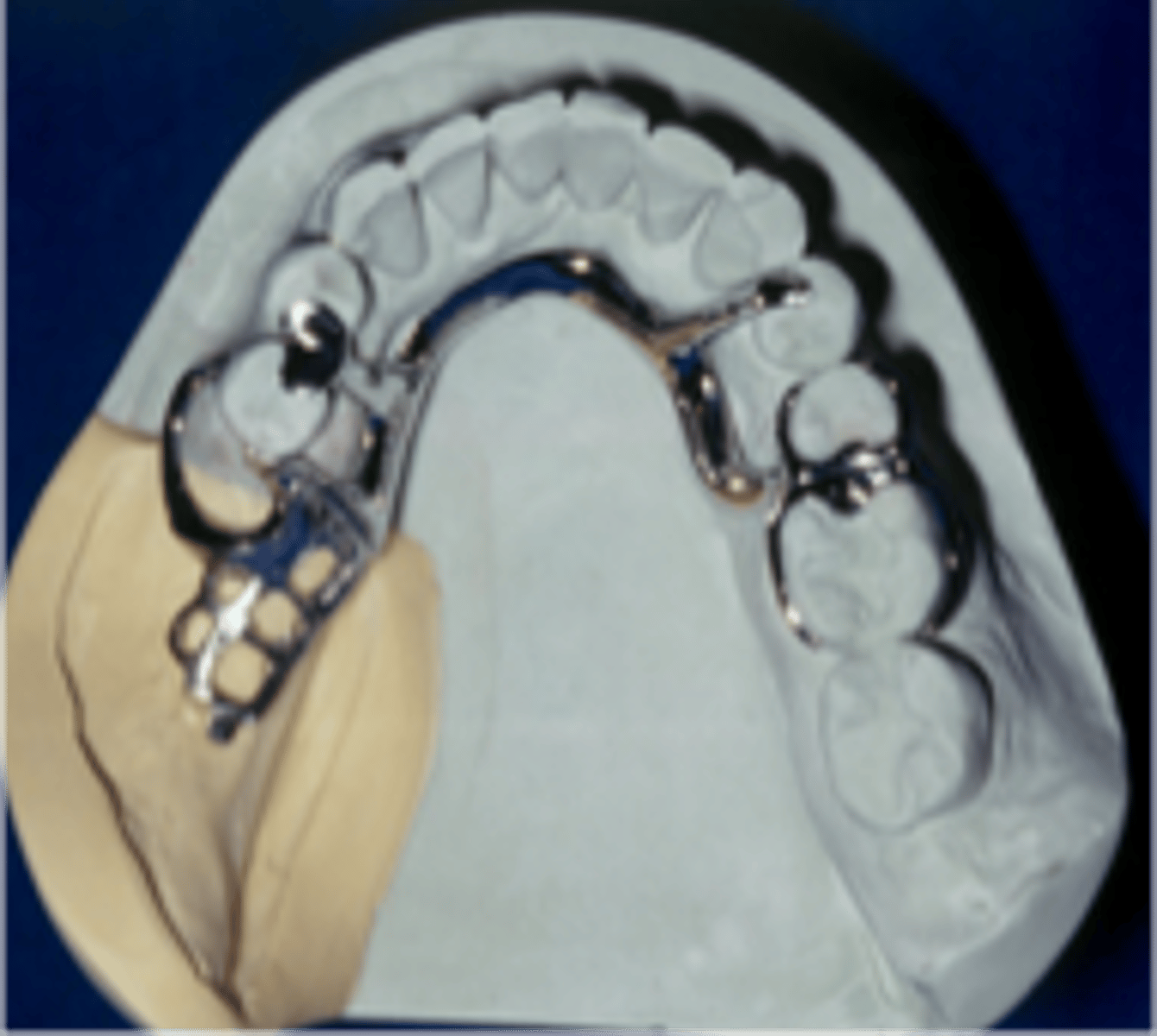 <p>Indirect retainer type that is most commonly used</p>