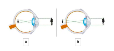 Eye “A” has which type of condition?