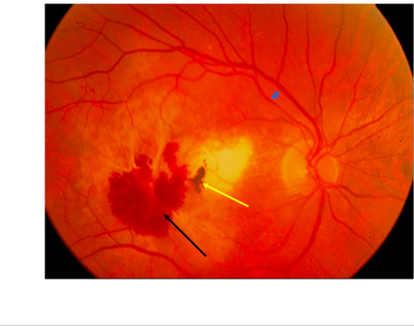 <p><u>Etio</u>: <strong>abnormal blood vessels grow under the retina, causing scarring,  <mark data-color="#ffe200" style="background-color: #ffe200; color: inherit">SUDDEN </mark>vision loss, </strong>damages center of retina (macula→allows vision of fine details @ central vision), leading cause of permanent vision loss (elderly), bilateral deterioration of central vision</p><p><u>Risks</u>: smoking, obesity, DM, HTN, blue eyes, CV dx, farsighted</p><p><u>Complications</u>: blindness</p><p><u>S&amp;S</u>: many small/large <strong><mark data-color="#ffe800" style="background-color: #ffe800; color: inherit">Drusen</mark></strong>, yellow deposits under retina, hazy spot in <strong>central vision</strong>, difficulty adjusting bright → low light</p><p><u>Tx</u>: <strong><mark data-color="#ffe200" style="background-color: #ffe200; color: inherit">Vit C &amp; E, zinc, Cu, lutein &amp; zeaxanthin</mark></strong></p>