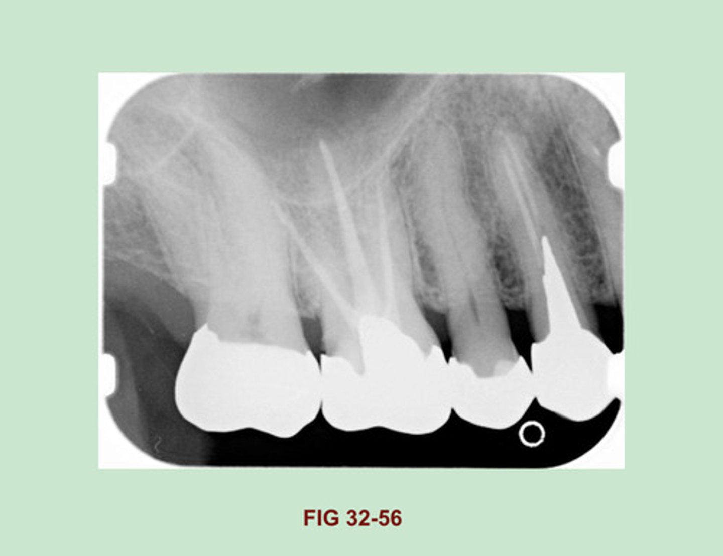 <p>Gutta Percha</p><p>Side Note: Gutta Percha is a RUBBERLIKE material used in endodontic therapy to fill the canals of the pulp. Gutta percha appears radiopaque, similar in density to that of base materials (Figure 32-31). Compared w/ metallic restorations, gutta percha appears LESS radiopaque.</p>
