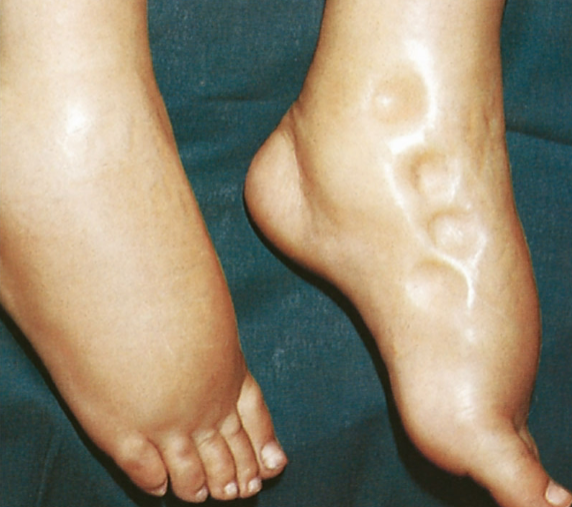 <ol><li><p>Swelling - local area&nbsp;</p></li><li><p>Pitting edema&nbsp;</p></li><li><p>Inc. in body weight&nbsp;</p></li></ol><p></p>