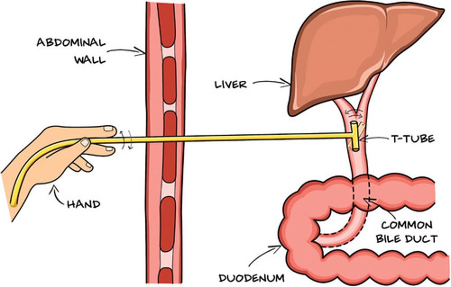 <p>placed endoscopically within the common bile duct for the purpose of drainage, allows for gravity drainage out skin</p>