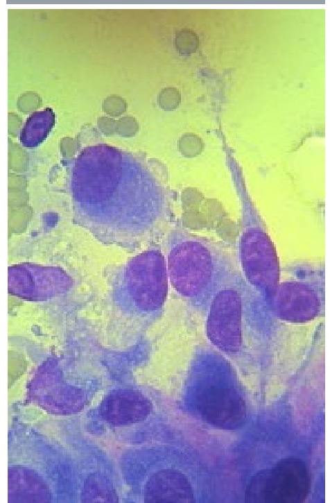 <ul><li><p>Mesenchymal </p></li></ul><p></p>