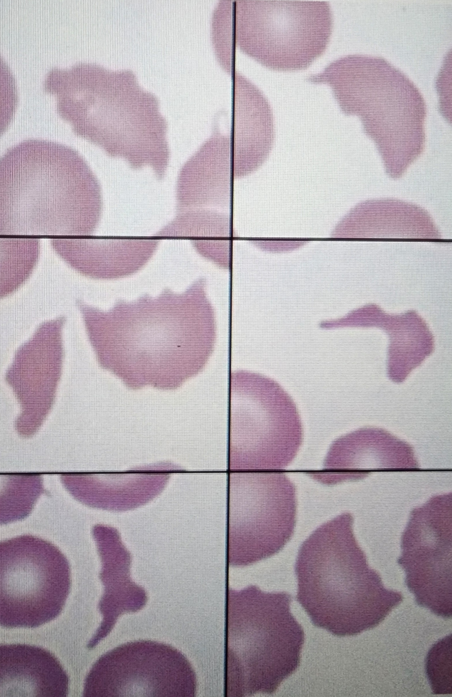 <p>Damaged/torn often crescent shaped</p>