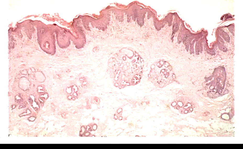 <ul><li><p>Thickened epithelium, forms pegs or projections of epidermis into the dermis</p></li></ul><p></p>