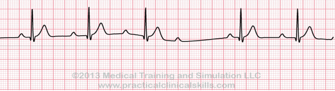 <p>what is 2ND DEGREE TYPE 1 HEART BLOCK</p>