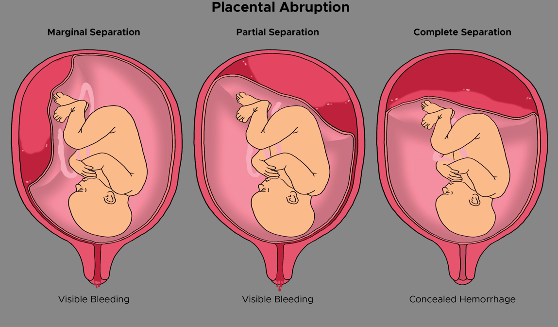 <ul><li><p><strong>Marginal</strong>: Blood passes between the fetal membranes and the uterine wall and escapes vaginally.</p></li><li><p><strong>Central</strong>: Placenta separates centrally, and blood is trapped between the placenta and uterine wall (concealed bleeding).</p></li><li><p><strong>Complete</strong>: Massive vaginal bleeding (almost total separation).</p></li></ul><p>___________________________________________________________________</p><ul><li><p><strong>Class O</strong> = Asymptomatic</p></li><li><p><strong>Class I</strong> = Mild; most common</p></li><li><p><strong>Class II</strong> = Moderate; mom and fetus show distress</p></li><li><p><strong>Class III</strong> = Severe; maternal shock and fetal death likely</p></li></ul><p></p>