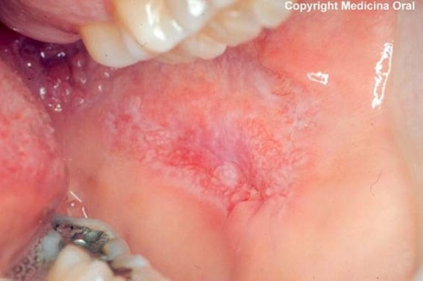 <p>autoimmune disease</p><p>• oral lesions = lichenoid appearance</p><p>• common locations (oral): buccal mucosa, gingiva, palate</p><p>• skin = malar rash</p><p>• population: middle-aged females, african americans</p>