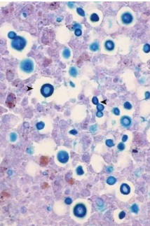 <p>8.1 Side B (PBD9: 387; BP9: 829)<br></p>
<p><br></p>
<p>Questions<br></p>
<p>A 36-year-old man with a 3-day history of headache and fever has nuchal rigidity. His CD4+ lymphocyte count is 82/µL (nl 490–1740/µL). A lumbar puncture reveals the causal organisms as shown.<br></p>
<p><br></p>
<p>1. What is your diagnosis?<br></p>
<p>2. What other tissue sites does this organism commonly infect?<br></p>
<p>3. What underlying disease does this patient likely have?<br></p>