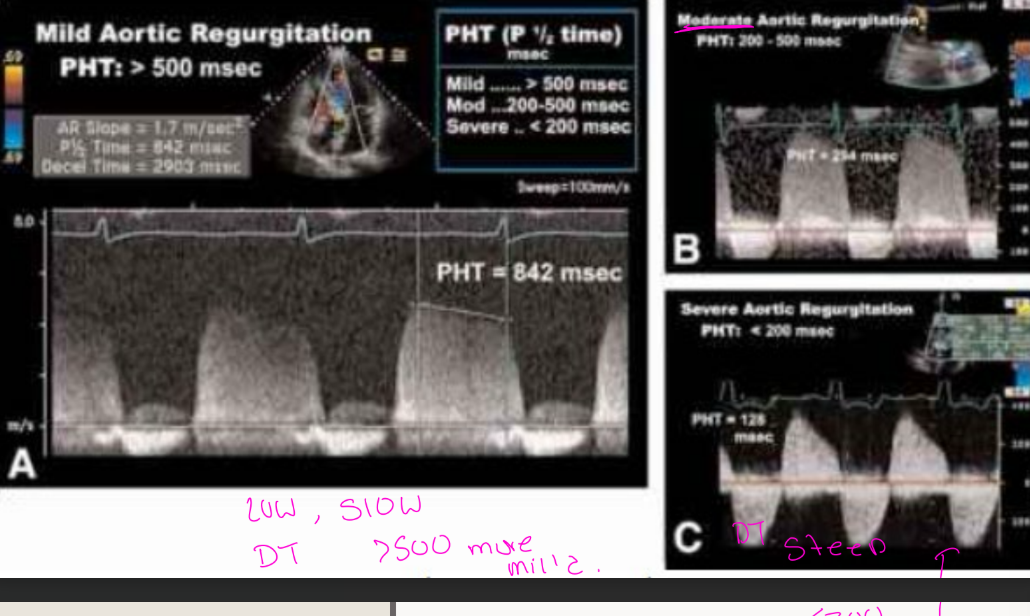 <p>Shape of CW Doppler reflects pressure</p><p>changes</p><p>Severe AR may become asymmetrical</p><p>reflecting rapid equalization of pressure</p>