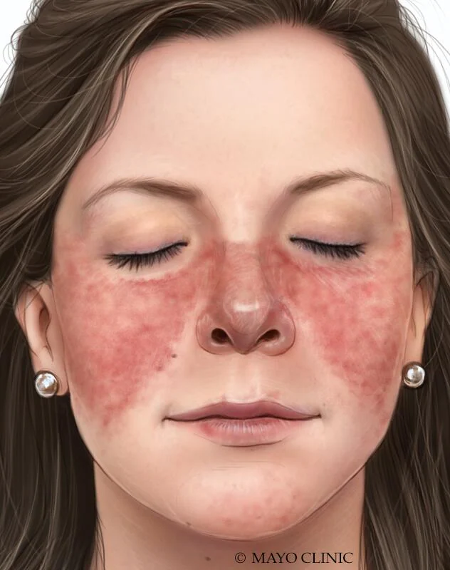 <ul><li><p>A classic sign of <strong><em>systemic lupus erythematosus</em></strong></p></li><li><p>Lesions appear on the cheeks and bridge of the nose in a butterfly-shaped pattern</p></li><li><p>Ban cánh bướm</p></li></ul>