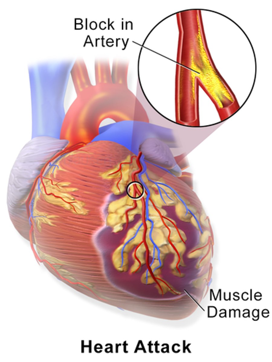 <p>Heart attack; Death of cardiac muscle due to ischemia.</p>