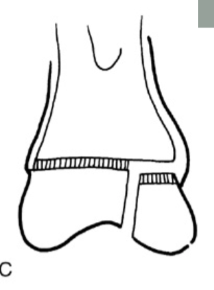 <p><strong>What type of Salter Harris fracture is the following:</strong></p><p>Fx through Physis w/ Epiphysis fragment</p>