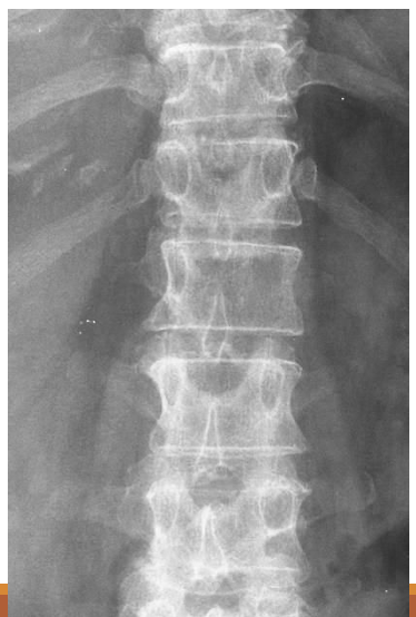 <p>Since the spine is a common metastasis point, what is an early sign on the AP view</p>
