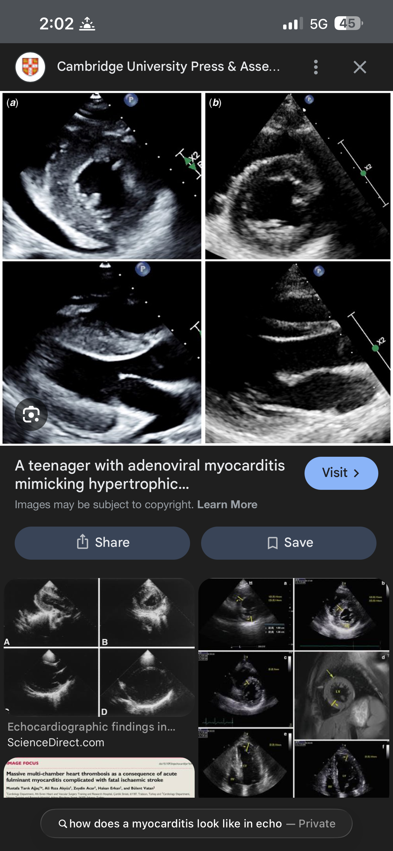 <p>What are findings in Myocarditis of 2D echo?</p>