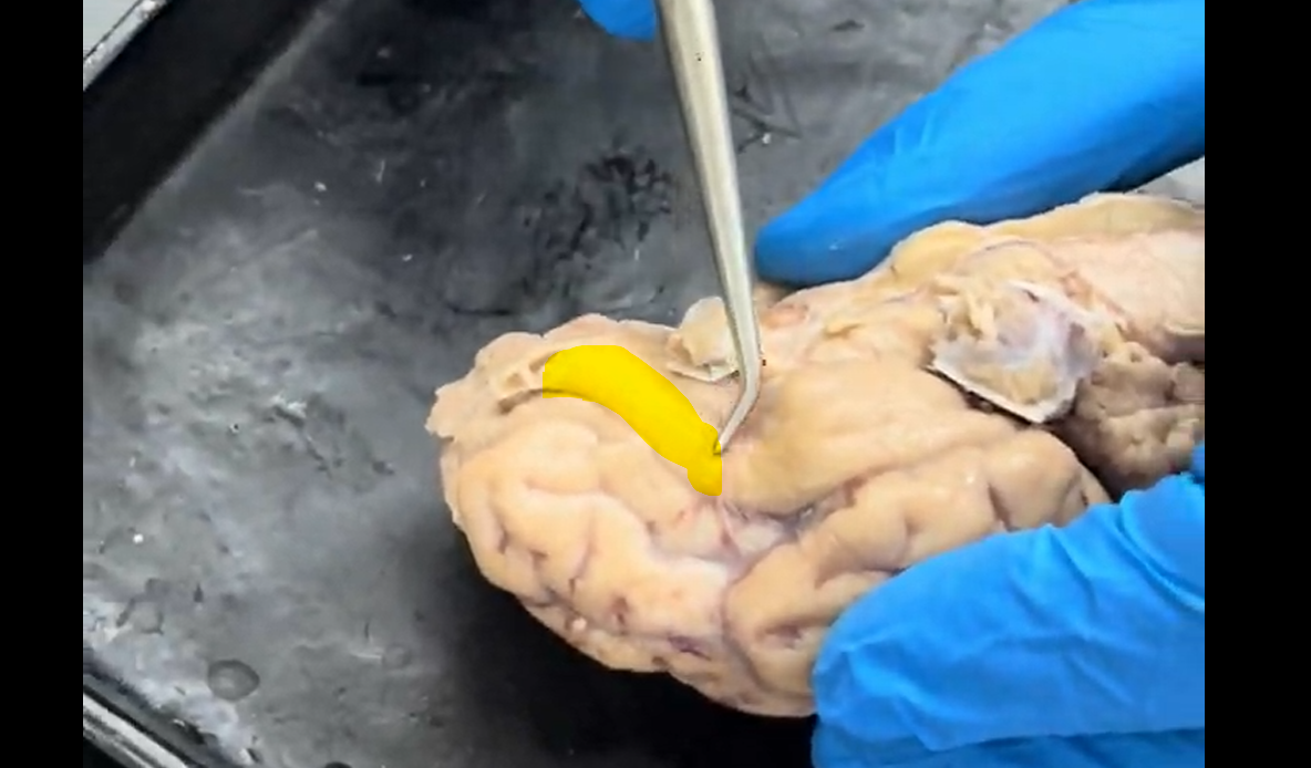 <p>Name the part of the brain at the tip of the probe and highlighted in yellow.</p>