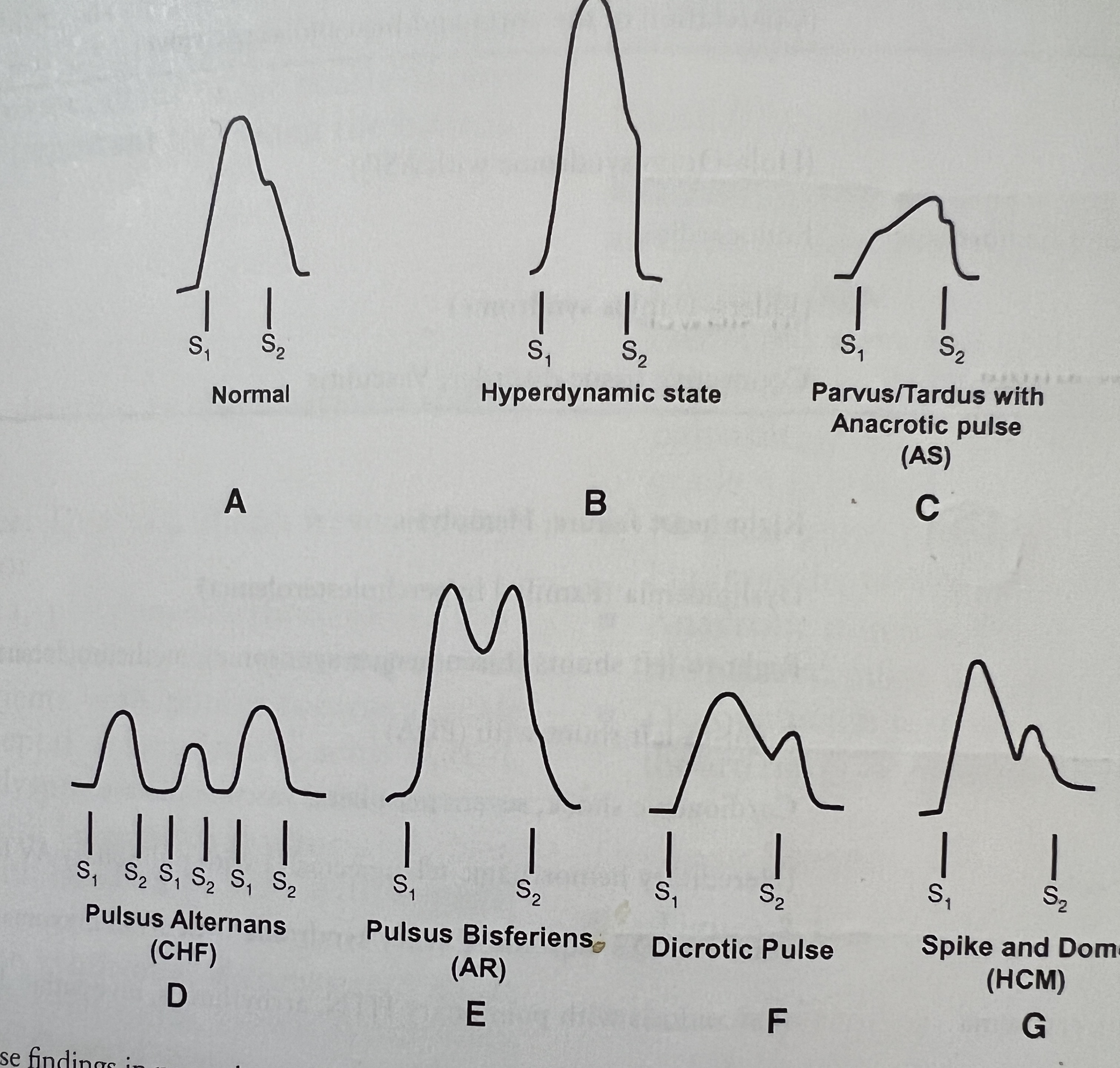 <p>What characterizes a normal carotid pulse?</p>