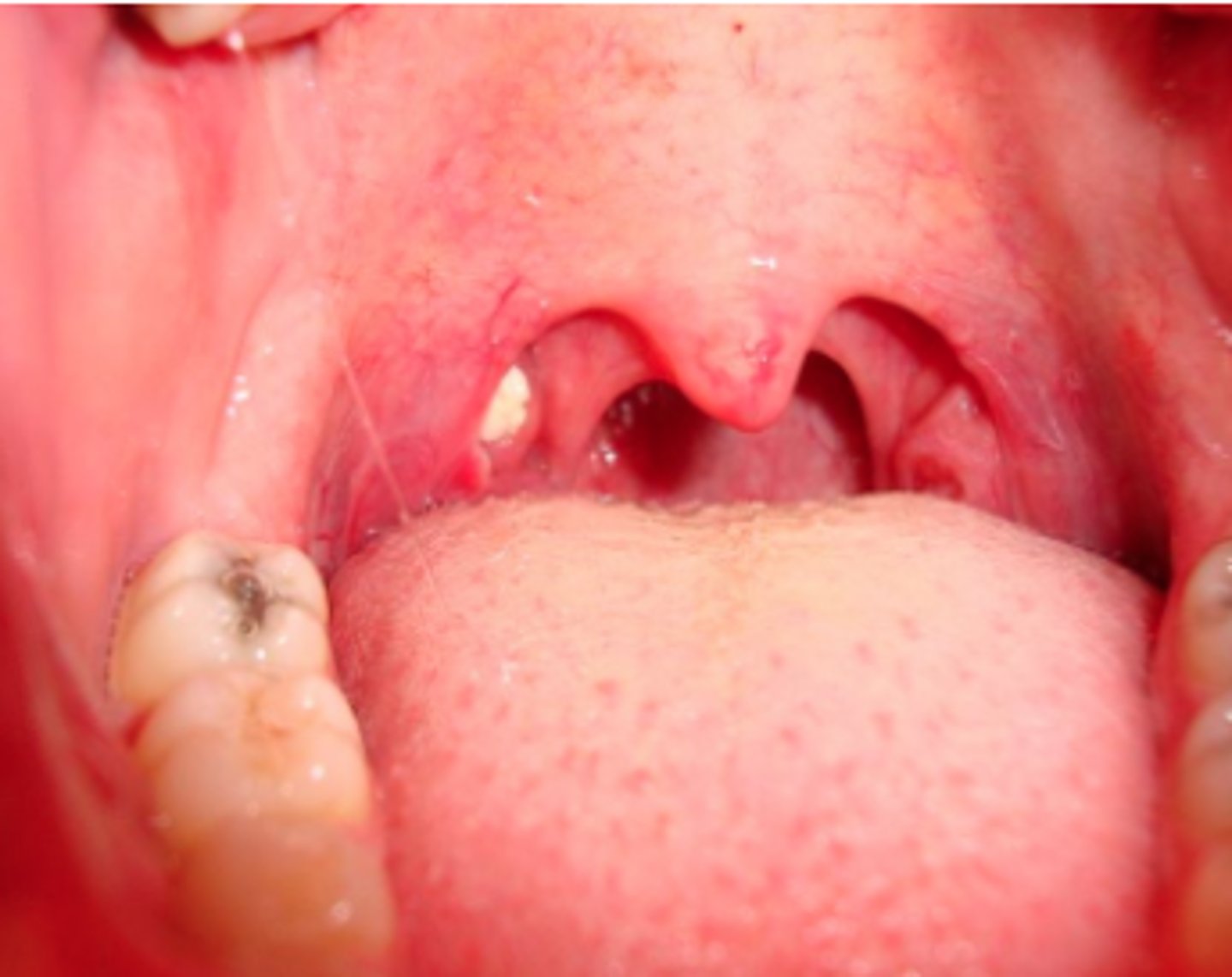 <p>- debris trapped in crypts</p><p>- food can get in between and then calcify</p>