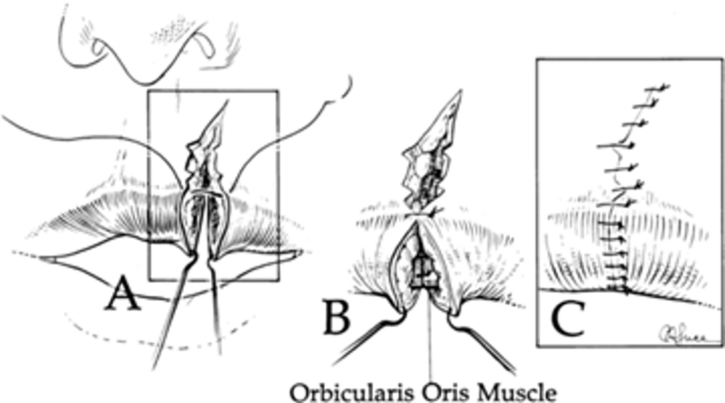 <p>Approximate vermillion border first and place suture</p><p>Then start from outside and work down</p><p>(mucosal tissues heal quickly, the main focus should be final cosmetic appearance of lip)</p>