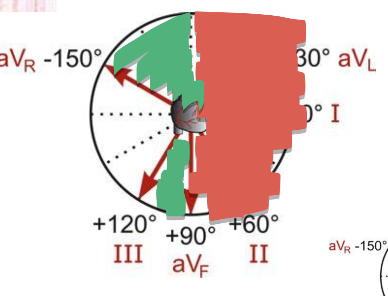 <ul><li><p>biphasic: aVF</p></li><li><p>what is perpendicular to aVF? → Lead I</p></li><li><p>is lead I’s tracing + or - ? → -</p></li><li><p>is lead III’s tracing + or - ? → +</p></li><li><p>what is perpendicular to lead III? →aVR</p></li><li><p>is aVR’s tracing + or - ? → more +</p></li><li><p>is it closer to lead III or aVR? → closer to aVR since the + deflections are higher</p></li><li><p>any possible axial deviations? → could be EAD</p></li></ul><p></p>