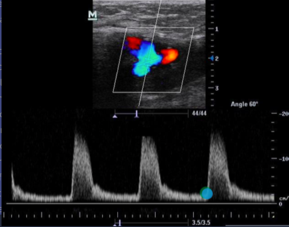 <p>Where does the first caliper go when measuring the acceleration time on PW Doppler? Use your mouse to position the cursor over the correct part of the 3rd waveform and click to set your answer.</p><p></p>