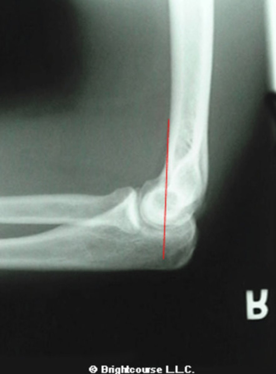 <p>What line is being drawn in this image?</p>