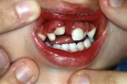 <p>what type of periodontal tissue injury is this</p>