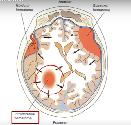 <ul><li><p>Whiplash: stopping too quickly</p></li><li><p>COUP injury: directly in injury site</p></li><li><p>Counter COUP: opposite injury site</p></li><li><p>BRAIN HEMATOMEAS: collection of blood</p><ul><li><p>Epidural: between skull & dura mater; rapid bleeding (meningeal artery tearing) → unconscious → lucid period</p><ul><li><p>Brain compression; good prognosis</p></li><li><p>HA, V, confusion, drowsy</p></li></ul></li><li><p>Subdural: dmg in bridging veins (dura -arachnoid mater)</p><ul><li><p>Bleeding progresses quickly → ^^^ ICP → high mortality</p></li></ul></li><li><p>Intracerebral: anywhere in brain (trauma or hemorrhagic stroke)</p><ul><li><p>size & location → Vomiting</p></li><li><p>resolves by itself of through surgery</p></li></ul></li><li><p>Subarachnoid: (arachnoid-pia mater)</p><ul><li><p>From cerebral aneurysm/trauma; rapid onset</p></li><li><p>R/xL intracranial aneurysm, HTN, smoking, ETOH, cocaine</p></li><li><p>s/s: vomiting, AMS, fever, seizure</p></li></ul></li></ul></li></ul><p></p>