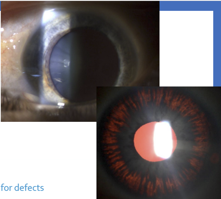 <ul><li><p>Magnification: 10X</p></li><li><p>Beam Height: 3-6 mm</p></li><li><p>Beam Width: 4-6 mm</p></li><li><p>Filter: IN; OUT for retroillumination </p></li><li><p>Angle: click-stop </p></li></ul><p></p>