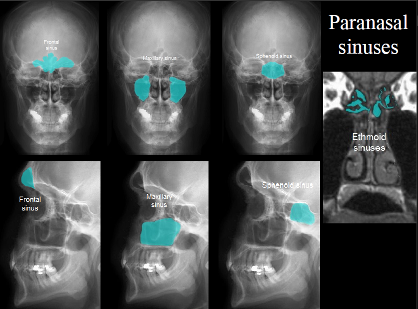 <p>any of the paired sinuses in the bones of the face adjacent to the nasal cavity that are lined with mucous membrane that is continuous with the lining of the nasal cavities</p>