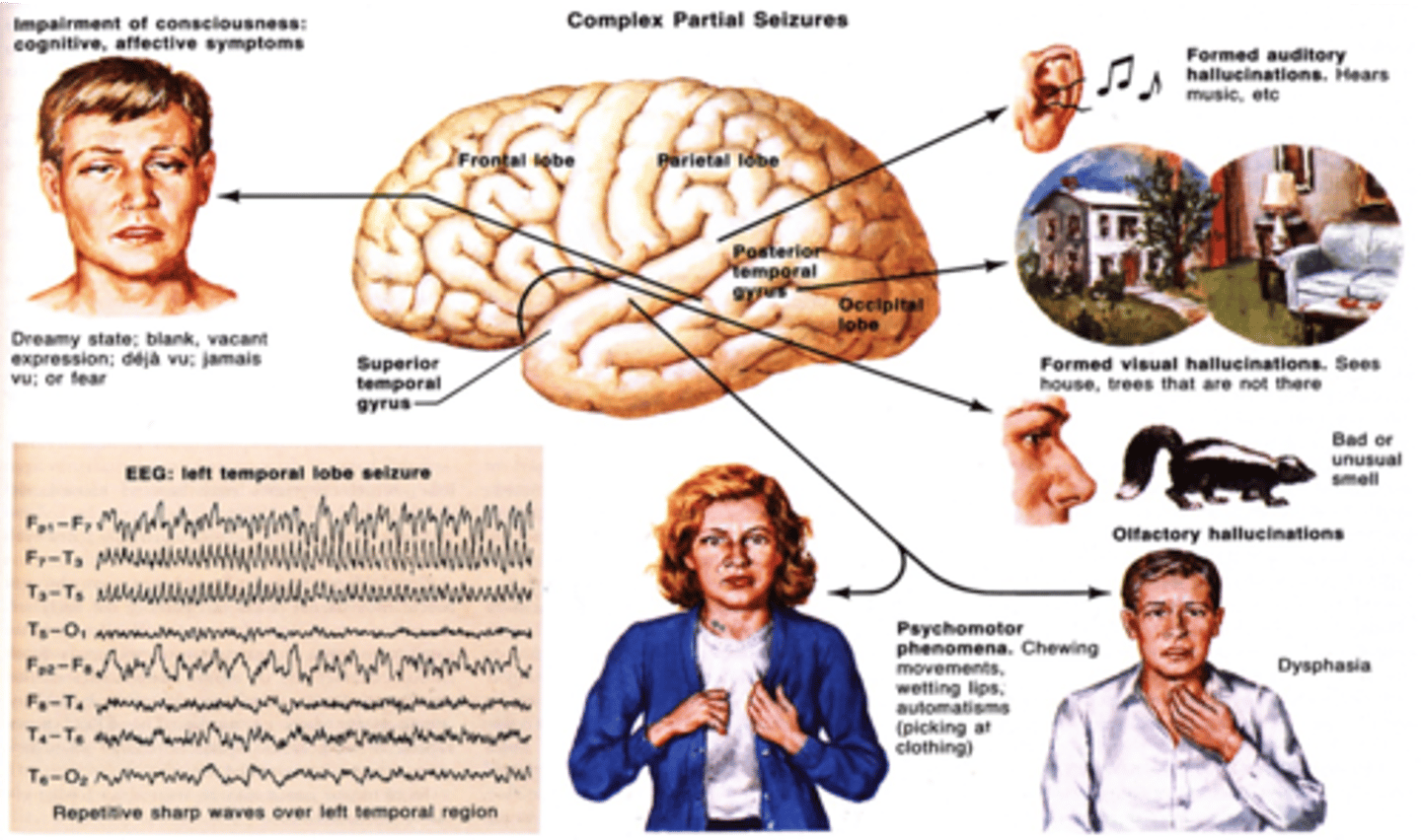 <p>in epilepsy, a type of seizure that doesn't involve the entire brain and therefore can cause a wide variety of symptoms</p>