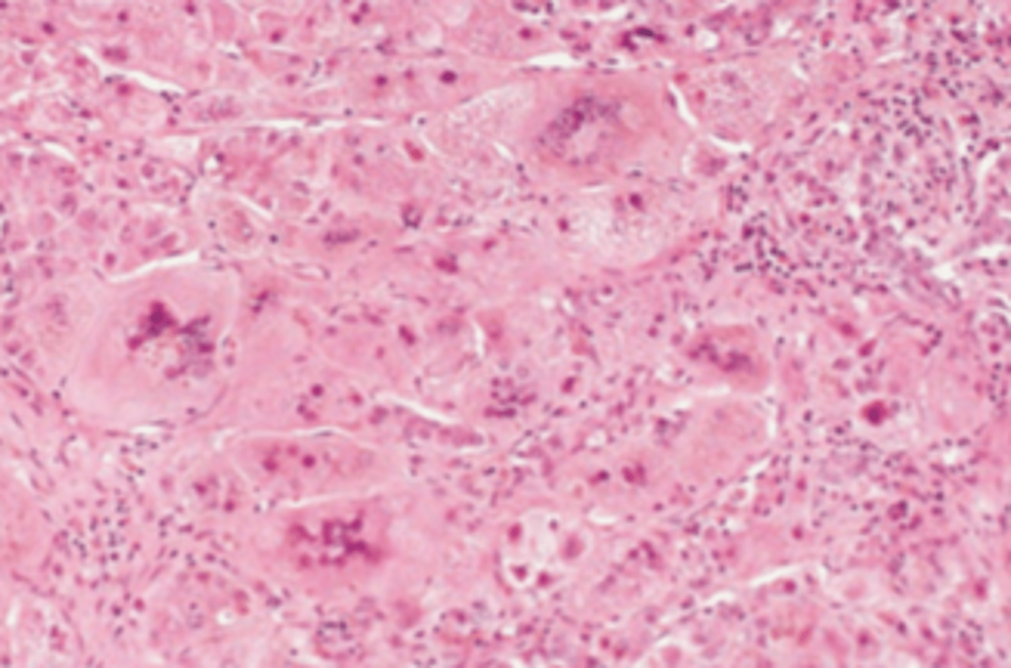 <p>A 4-week-old infant has been evaluated for jaundice and hepatomegaly since birth. Laboratory studies reveal markedly elevated serum levels of bilirubin and alkaline phosphatase and high serum levels of AST and ALT. A liver biopsy is shown in the image. Which of the following is the most likely diagnosis?</p><p>(A) Autoimmune hepatitis</p><p>(B) Dubin-Johnson syndrome</p><p>(C) Neonatal hepatitis</p><p>(D) Reye syndrome</p><p>(E) Sclerosing cholangitis</p>