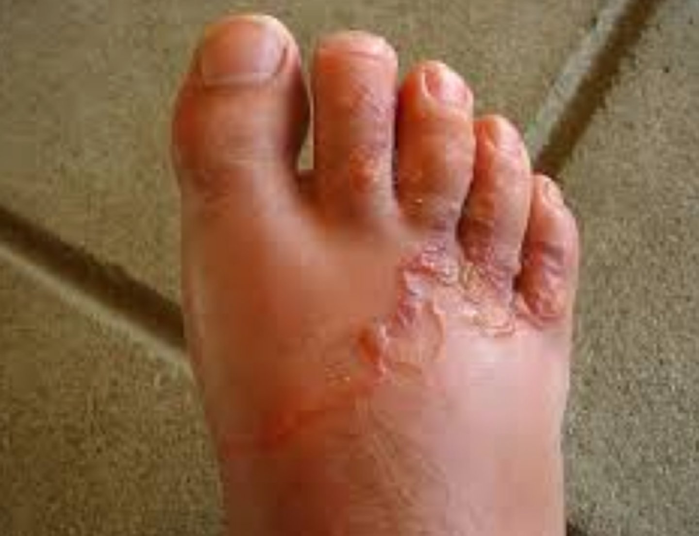 <p>Cutaneous larva migrans is associated with ___</p>