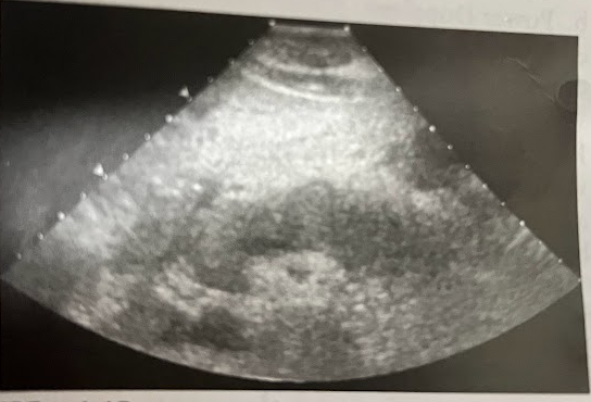 <p>A 33 year old man w/a hx of alcoholism presents w/acute onset of epigastric pain, N/V, elevated WBC, elevated serum amylase, and increasing lipase level. The entire pancreas is enlarged and hypoechoic w/well-defined borders. What is the most likely diagnosis?</p>