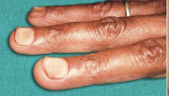 <p>Spoon like nails </p>