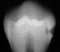 <p>caries classification?</p>