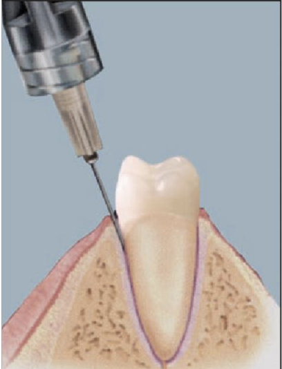 <p>Intra-ligamental/PDL</p>
