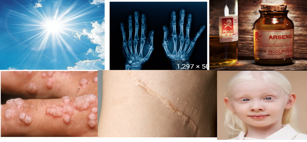 <ol><li><p>UV radiation</p></li><li><p><strong>Medical radiation-</strong> more likely in squamous cell</p></li><li><p>Some chemicals- specially arsenic</p></li><li><p><strong>HPV virus</strong>- specially in squamous cells cancers</p></li><li><p><strong>Scars or Chronic Inflammatory Conditions-</strong> in squamous cell cancers</p></li><li><p>Genetic disorders including albinism</p></li></ol><p></p>