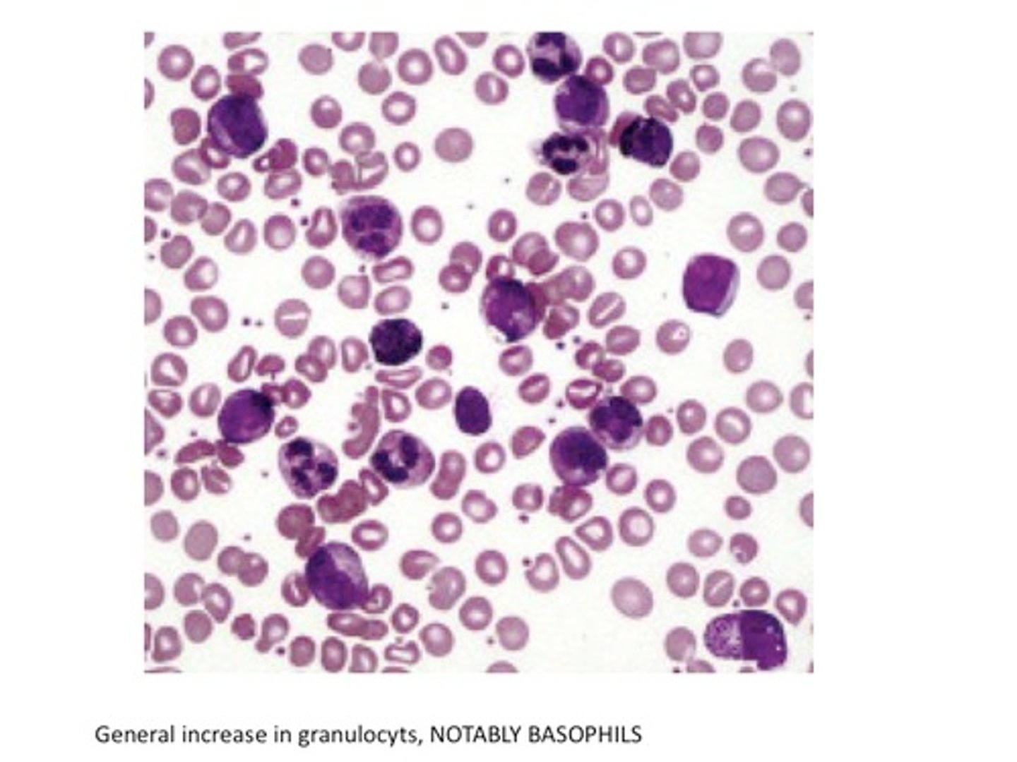 <p>Group of cancers that usually begin in red bone marrow and result in abnormal white blood cells.</p>