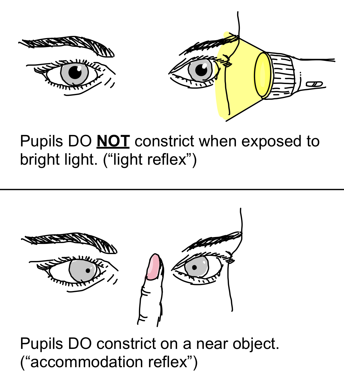 <p>PP: small+irregular+bilateral pupils</p><p>E: neurosyphilis<br>diabetes (rare)</p><p>CM/PE:<br>near vision→constriction<br>far vision→dilation<br>light reaction→no reaction</p>